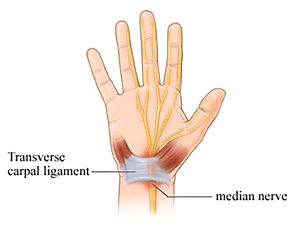 Computer-related overuse injuries of the hand or arm